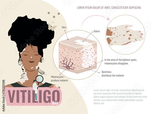 A woman with black hair and a green shirt is shown with an illustration of a skin condition called vitiligo. Graphic scheme of the skin with this disease.Vitiligo disease education concept photo