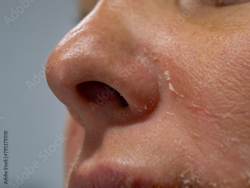 CLOSE UP, DOF: Peeling of dry skin around the nose and cheeks of a young person. Harmful consequences due to carelessness in summer sunbathing, which can gradually lead to development of skin cancer. © helivideo