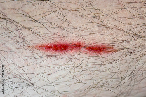 Close-up of skin with big scratch, bloody wound