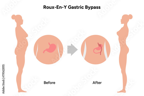 Roux-en-y gastric bypass, weight loss surgery photo