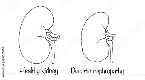 Diabetic nephropathy photo