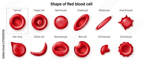 Shape variation of red blood cell morphology. Normal and abnormal erythrocytes. Target cell, Spherocyte, Ovalocyte, Elliptocyte, Acanthocyte, Tear drop, Sickle cell, Stomatocyte, Schistocyte and Echin