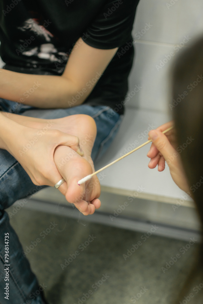 A dermatologist treats a wart with liquid nitrogen on a patient’s leg. skin lesions