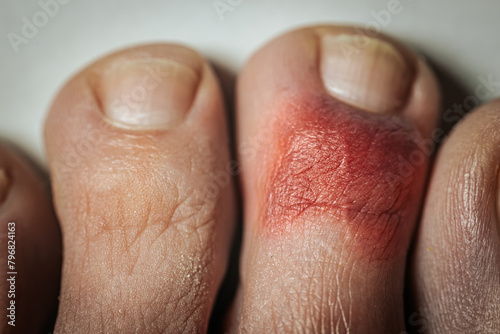Hematoma on the toe. Hemorrhage under the skin. Broken toe