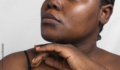 Brown skin with dark spots, hyperpigmentation on brown skin, african american woman with skin blemishes, imperfect skin photo