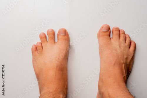 Male foot with shortest fourth toe. Brachymetatarsia Morton's foot, Greek foot, royal toe, peacock toe, Sheppard's toe, Viking toe, Morton's syndrome, long toe or boss toe, image for medical use. photo