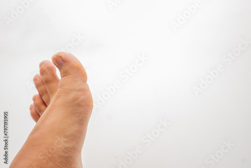 Dry skin, plantar callus and scales on the thumb on white background. Image for medical purposes.
