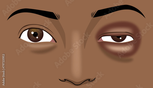 Close-up the black man's red eye is swollen, illustration drawing