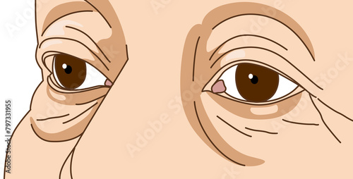 lose-up crow's feet eyes and puffy eye bag area on older woman, illustration