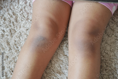 stain bruise wound on child knee.
