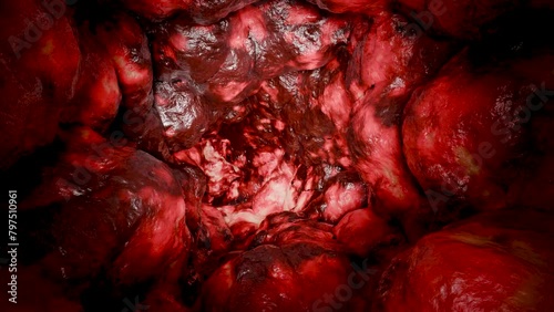 Colorectal cancer, malignant tumor in intestine, Endoscope inside colonoscopy, gut intestine, Colon polyp removal, inflammatory bowel Disease,  intestinal carcinoma, bowel neoplasia, 3d render photo
