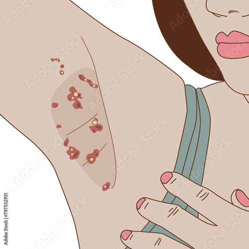 Hidradenitis suppurativa on woman's armpit, illustration on white background