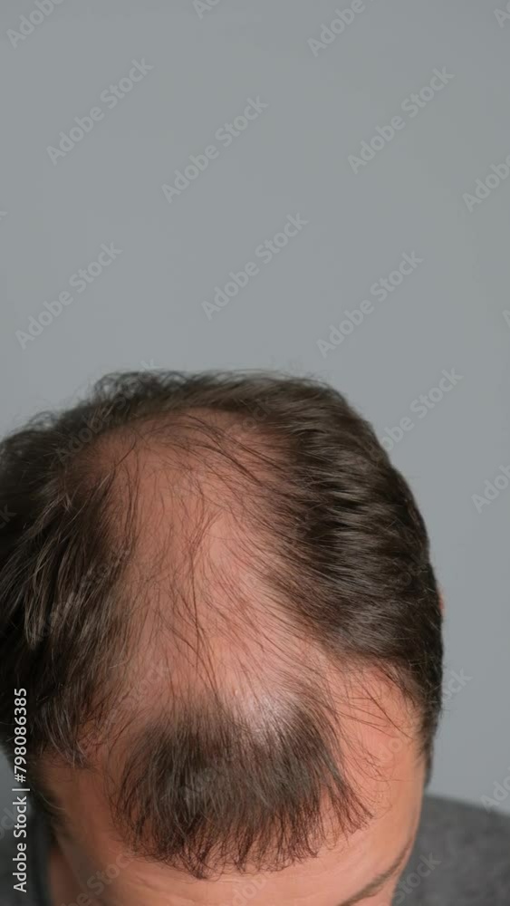 Man with hair loss problems close-up. Close-up of a young man with alopecia on a gray background. Vertical video. Man with hair loss problems close-up. Close-up of a young man with alopecia on a gray background. Vertical video.