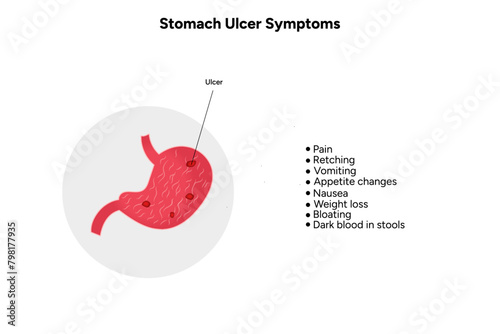 Stomach Ulcer symptoms 