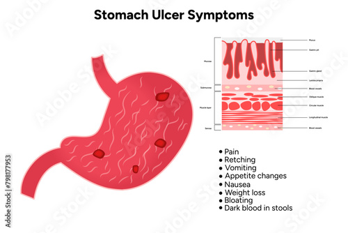 Stomach Ulcer symptoms 
