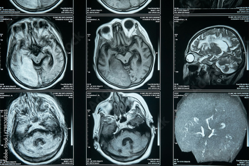 MRI imaging, diagnosis and treatment of brain diseases