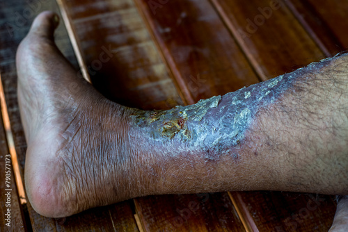 Diabetes foot Infected wound of medical dressing wound infection ,trchronic venous leg ulcereatment