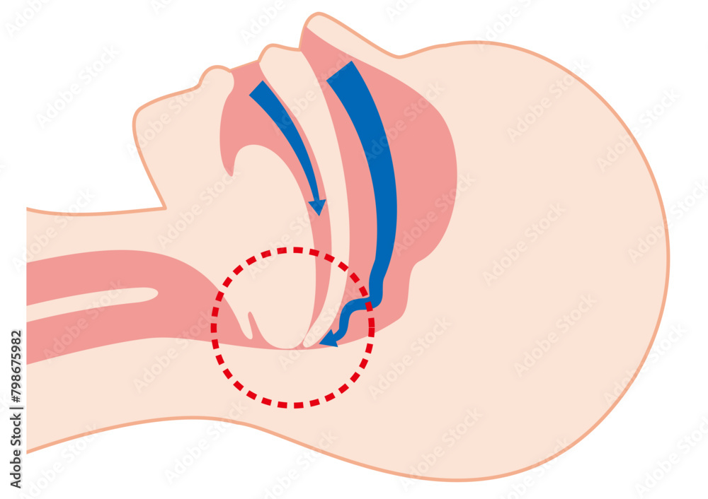 睡眠時無呼吸症候群のメカニズム 睡眠時無呼吸症候群のメカニズム