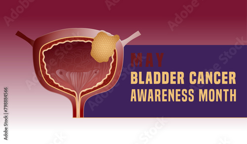 Urothelial carcinoma landscape poster. Urinary bladder cancer banner