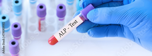 Doctor holding a test blood sample tube with ALP test on the background of medical test tubes with analyzes. Banner photo