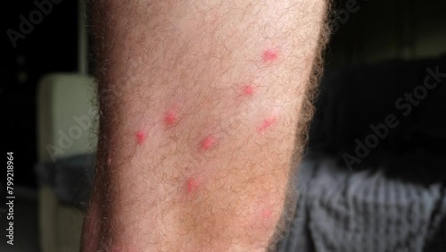 Close-up of man leg with visible mosquito bites. Skin care and insect repellent usage. photo