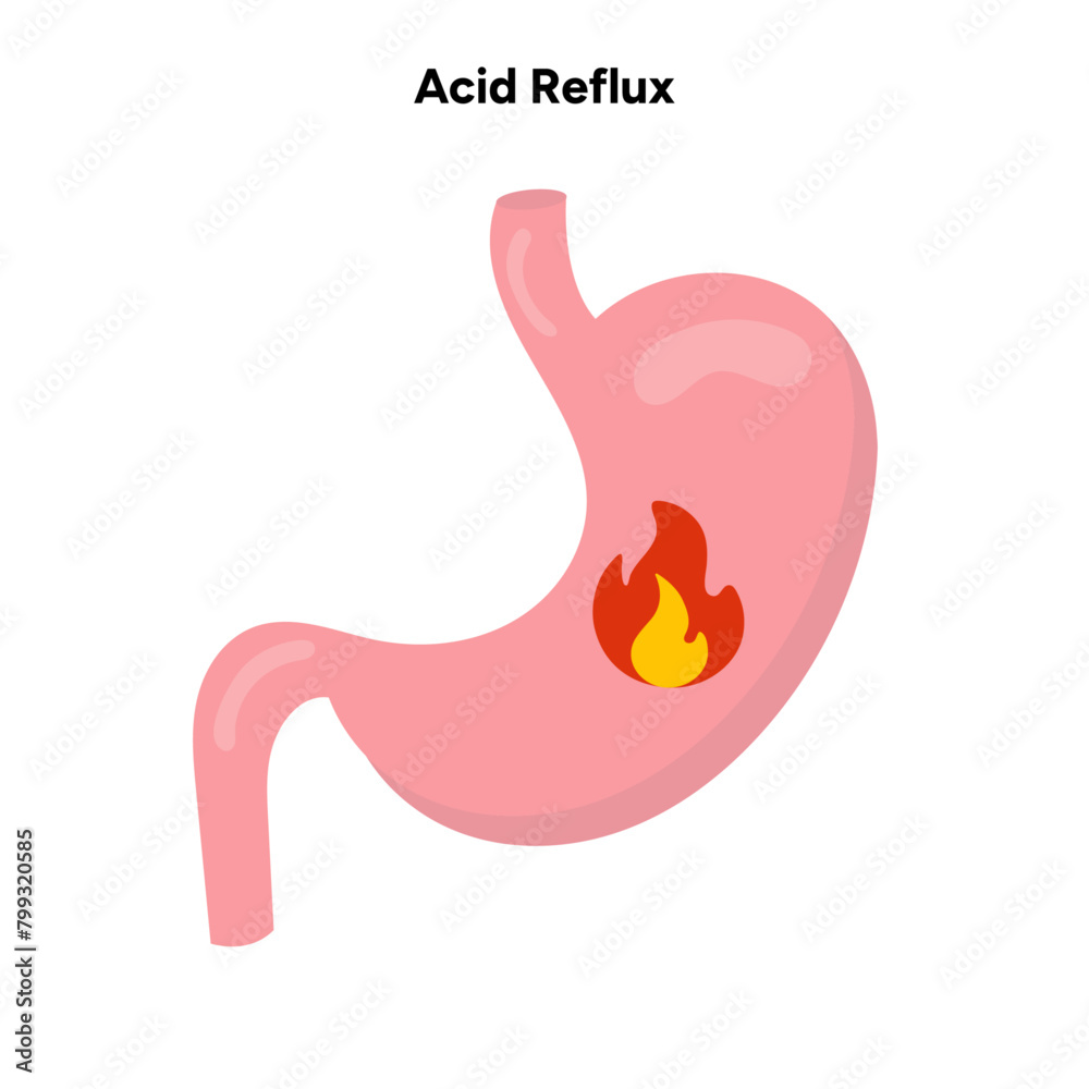 Acid reflux Acid reflux