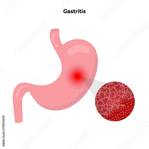 Gastritis, stomach problem
