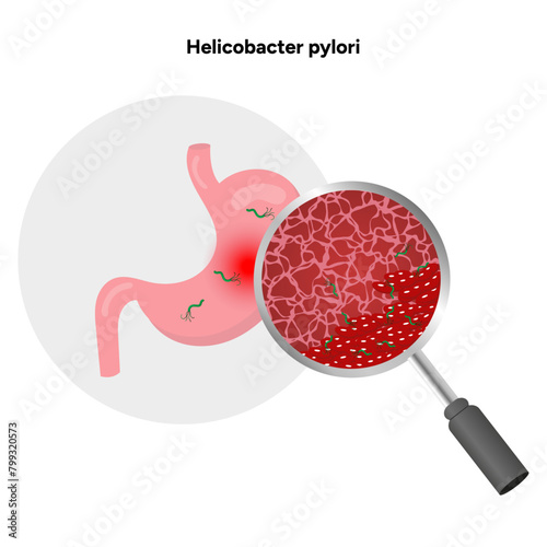 Helicobacter pylori