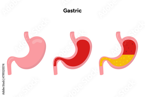 Gastritis, stomach problem