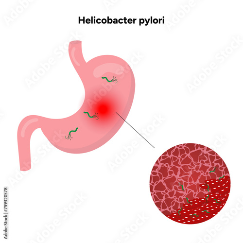 Helicobacter pylori