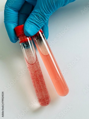Quadro su tela Agglutination reaction in laboratory test tubes