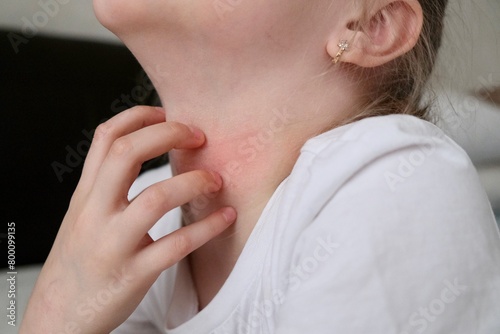 The child scratches atopic skin. Dermatitis, diathesis, allergy on the child's face.	