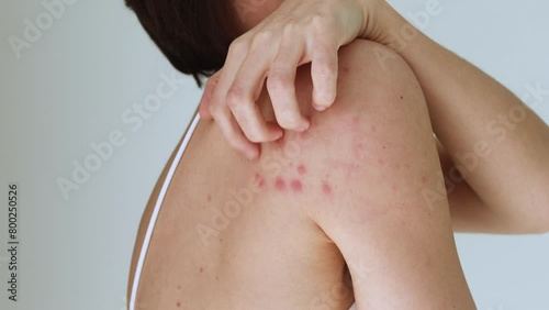 A woman scratches her shoulder bitten by a bedbug on a white background, close-up. Skin health problem. Red pimples.