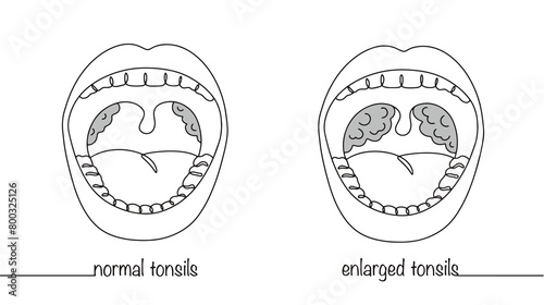 Palatine tonsils