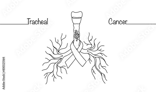 Tracheal cancer photo