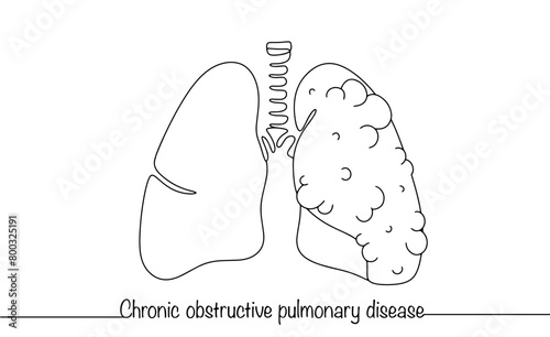Lung disease
