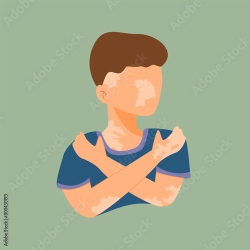 Portrait of a Boy with Vitiligo Wearing a Blue Shirt and hug his self