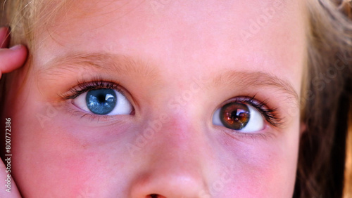 Close up portrait child girl with heterochromia eyes. Beautiful girl with with differently colored eyes. Looking at camera