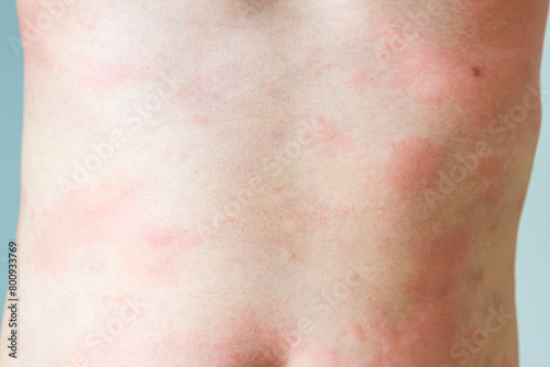 Young asian man itching and scratching on his back from allergic itchy dry skin eczema dermatitis insect bites