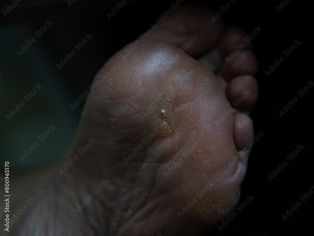 Naklejka premium callus on a woman's foot