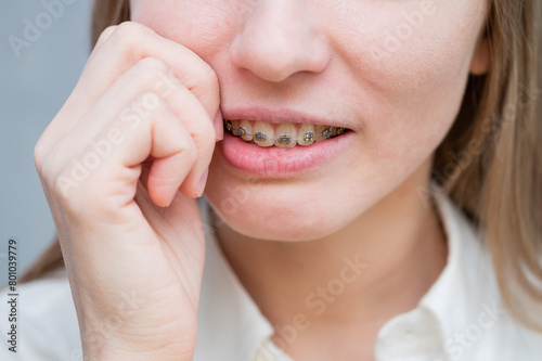 Close-up portrait of a red-haired girl suffering from pain due to braces. Young woman corrects bite with orthodontic appliance. © Михаил Решетников