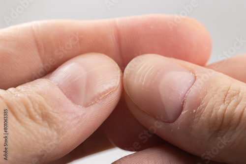 Ridged fingernails with vertical and horizontal ridges. Nails problems. © eliosdnepr
