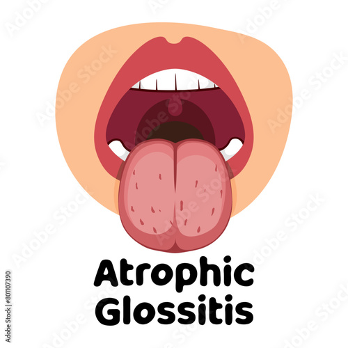 Atrophic Glossitis vector illustration