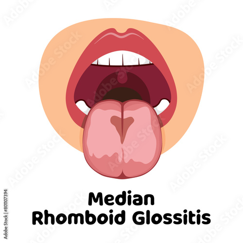 Median Rhomboid Glossitis Vector Illustration