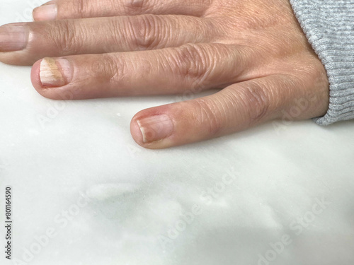 Принти на полотні female hand with brittle fingernail. Fungal infection