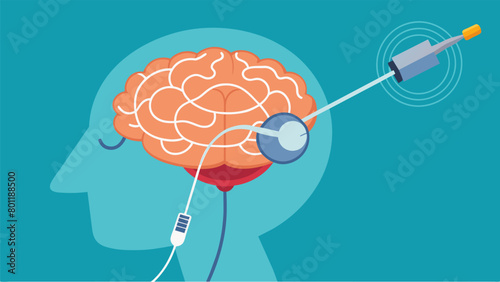 A closeup illustration of electrodes being p in the thalamus to help manage chronic pain through deep brain stimulation..