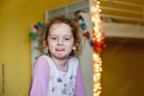 Portrait a sad little girl with chickenpox at new year home interior. Varicella virus.