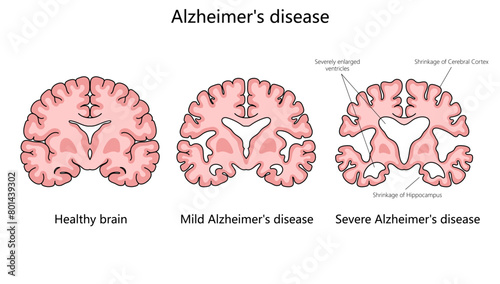 progression of Alzheimer disease, comparing a healthy brain to those with mild and severe Alzheimer structure diagram hand drawn schematic vector illustration. Medical science educational illustration