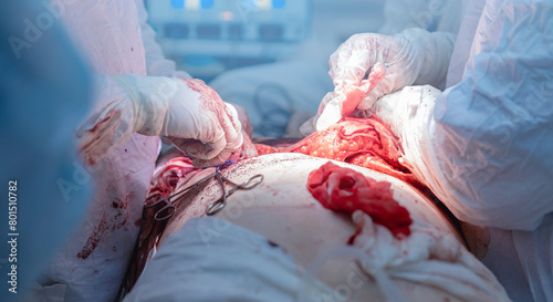 Abdominal plastic operation in hospital. Closeup surgeon in sterile gloves make tummy tuck surgery photo