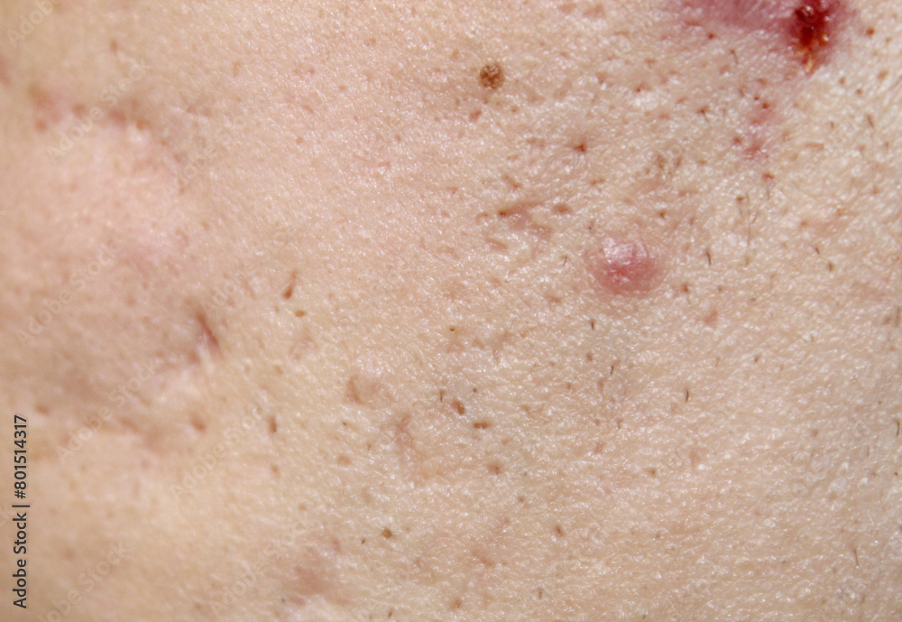 Problem skin with acne marks. Stock human skin texture in the best quality. Photo with scars. Problem skin with acne marks. Stock human skin texture in the best quality. Photo with scars.